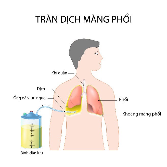 Tràn dịch màng phổi có nguy hiểm không? Cách xử lý như thế nào? 4