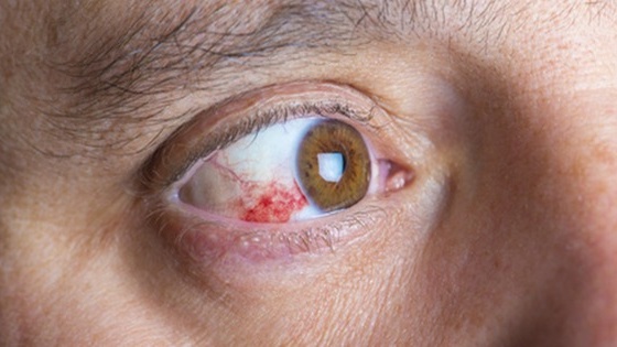 tray-xuoc-giac-mac-la-gi-nguyen-nhan-gay-tray-xuoc-giac-mac Cropped.jpg