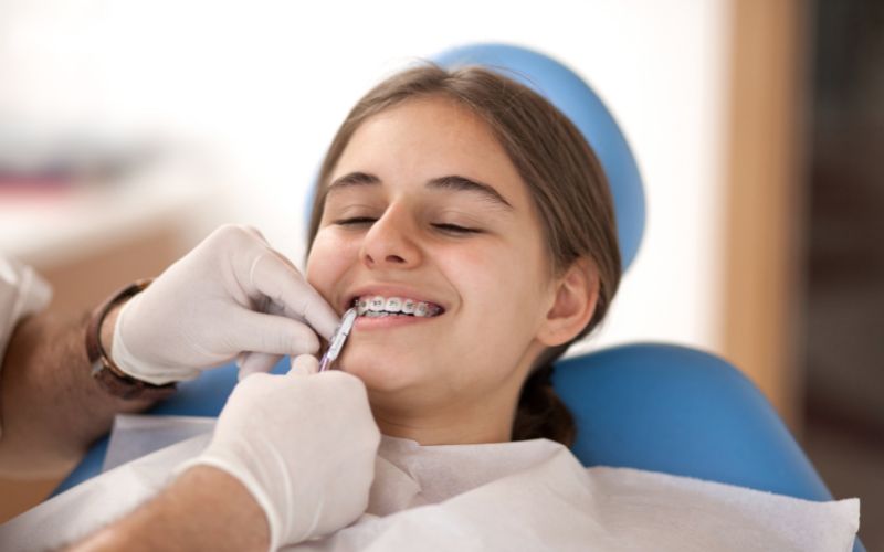 Trẻ 15 tuổi niềng răng bao nhiêu tiền? Niềng răng trong bao lâu? 5
