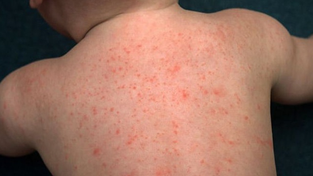 Trẻ bị ngứa về đêm: Nguyên nhân và cách khắc phục 1