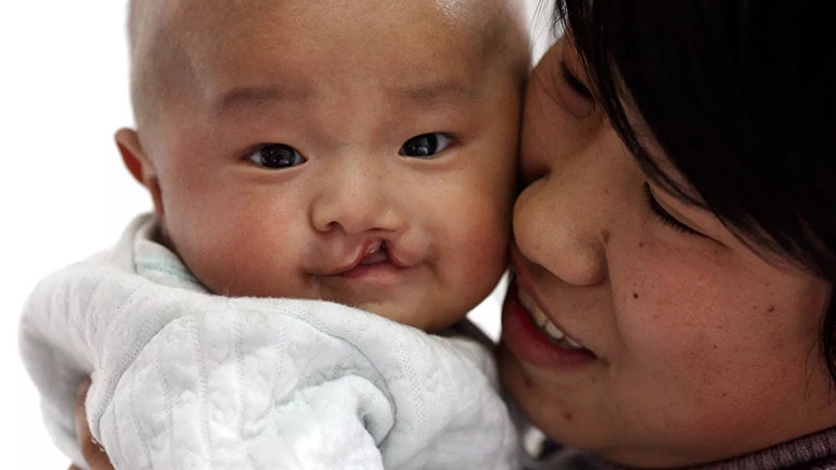 Trẻ bị sứt môi 4mm phải khắc phục như thế nào? 2