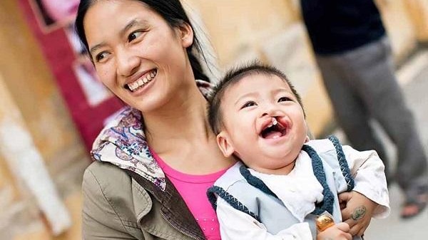 Trẻ bị sứt môi 4mm phải khắc phục như thế nào? 3