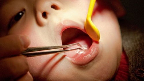 tre-nuot-di-vat-phai-xu-tri-nhu-the-nao-nhung-dieu-can-biet 3