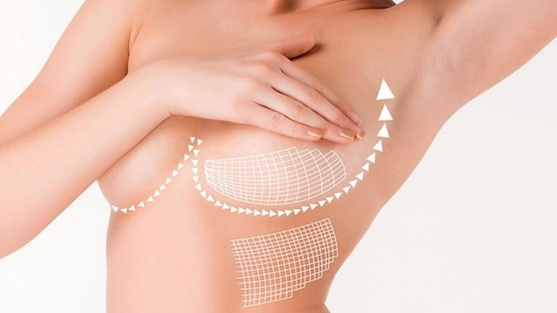 Treo sa trễ đường quầng là kỹ thuật nâng ngực bằng cách rạch quanh quầng vú
