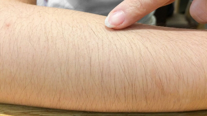 Triệt lông tay vĩnh viễn và những điều cần biết 2