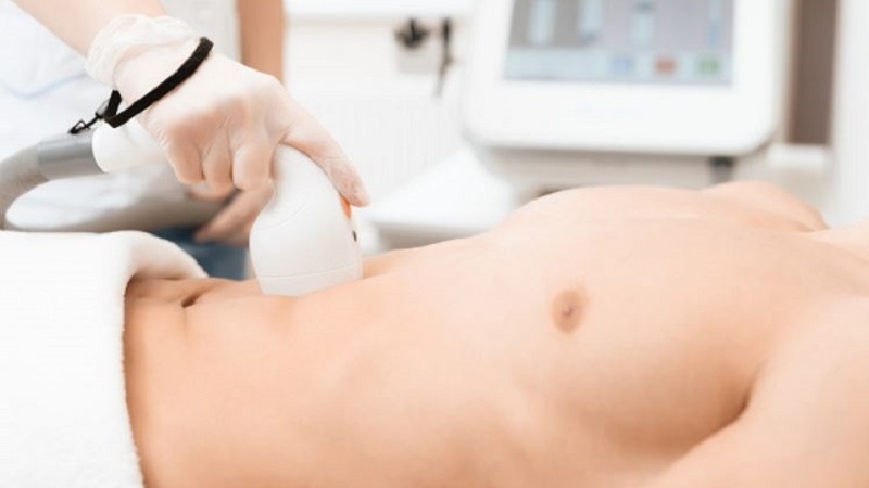 Triệt lông vùng kín nam và những lợi ích không ngờ 4