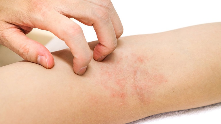 Mẹo giảm thiểu tình trạng triệt lông xong bị ngứa 1