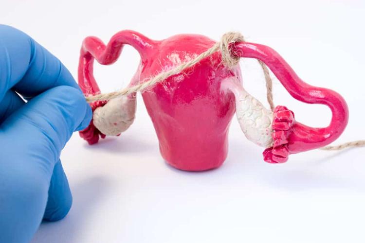 Triệt sản nữ là gì? Ưu nhược điểm ra sao và những ai nên thực hiện? 2