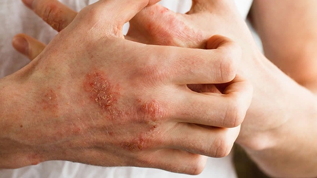 Triệu chứng nổi mụn nước ngứa khắp người là do đâu? 3