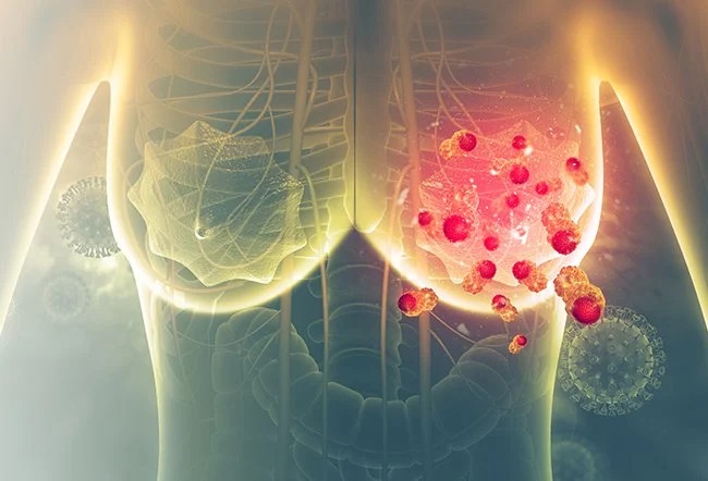 trieu-chung-ung-thu-vu-duong-tinh-voi-her-2 1.jpg