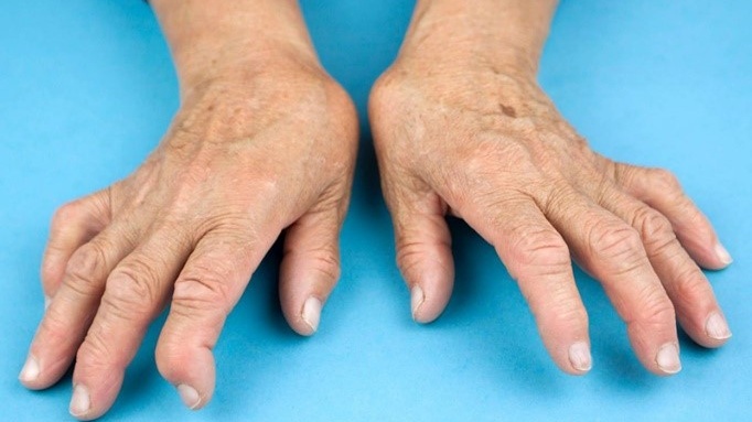 trieu-chung-viem-khop-dang-thap-la-gi 2