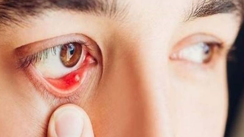 Trong mắt có hạt trắng là bị gì? Làm sao khắc phục? 1