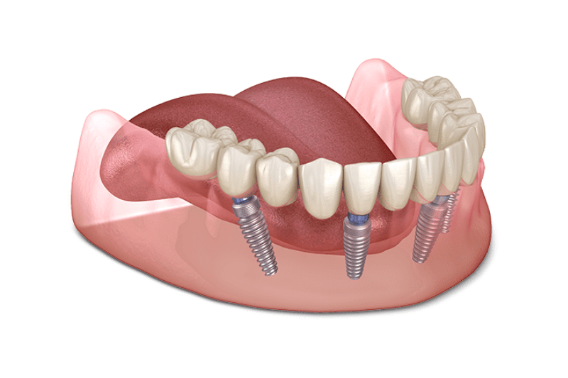Trồng răng implant toàn hàm - Giải pháp hiệu quả cho người mất răng 4