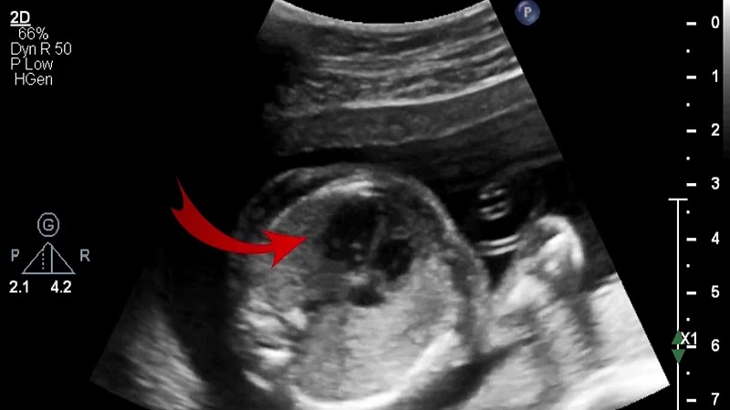 Trong trường hợp nào nốt echo gây nguy hiểm? 3