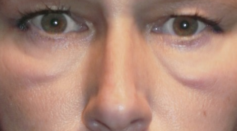 trung-ma-malar-mound-la-gi 2