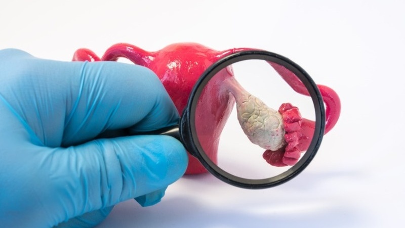 U bì buồng trứng kích thước bao nhiêu thì mổ? Các phương pháp mổ u bì buồng trứng 1