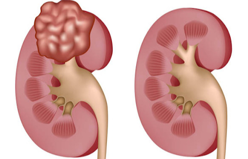 U cơ mỡ mạch thận là gì? Các dấu hiệu nhận biết u cơ mỡ mạch thận 2