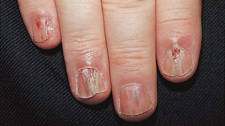 U cuộn mạch dưới móng - Quá trình phẫu thuật diễn ra như thế nào? 1