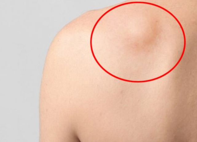 U mỡ ác tính có khả năng tiến triển thành ung thư không? 02