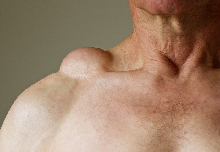 U mỡ dưới da là gì? Nguyên nhân và giải pháp điều trị 2