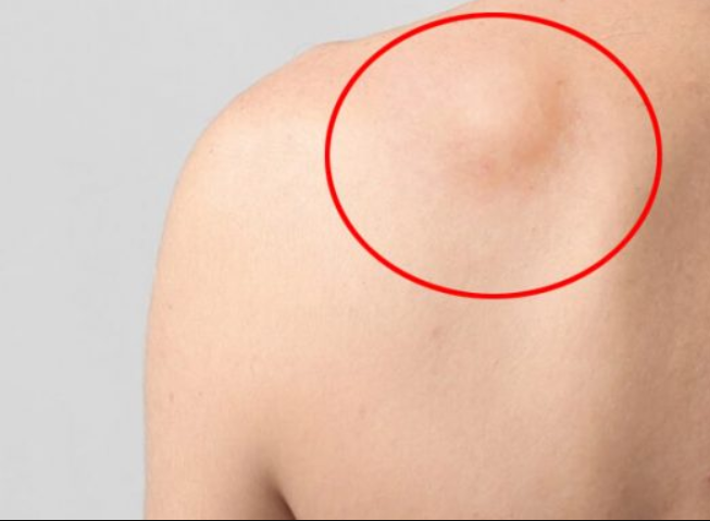 U mỡ ở vai là bệnh gì? Có nguy hiểm không? 1