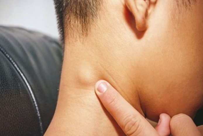 U mỡ sau gáy là gì? Có nguy hiểm không? 3