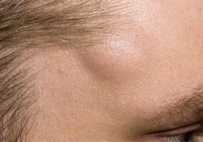 U mỡ trên mặt: Nguyên nhân vì sao? Làm sao để phát hiện? 3