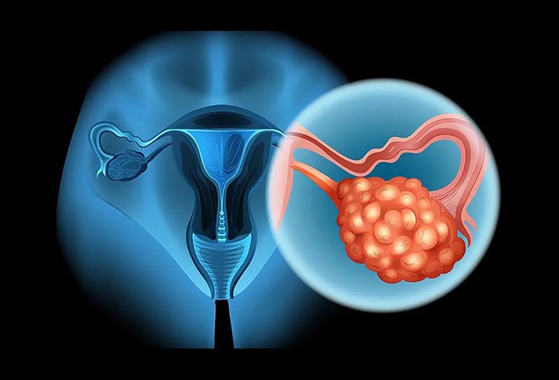 U nang buồng trứng có nên uống sữa đậu nành? 1