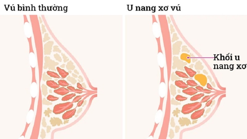 U nang vú là bệnh gì?? U nang vú kiêng ăn gì? 1