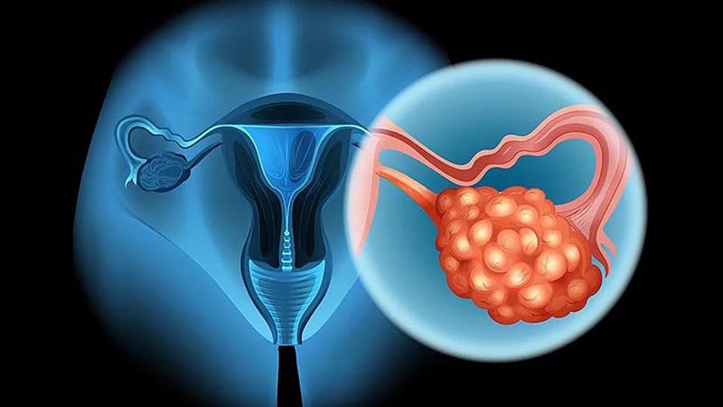 U tế bào mầm buồng trứng là gì? Có điều trị được không? 1