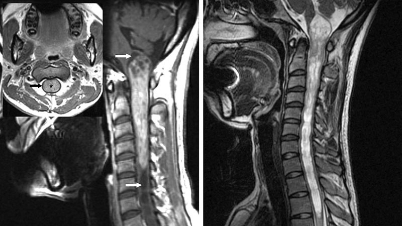 U tủy sống nguyên phát nội tủy: Dấu hiệu, phân loại và chẩn đoán 1