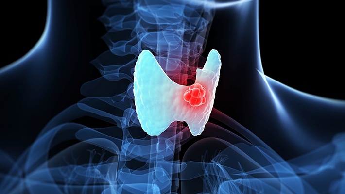 U tuyến giáp ác tính có chữa được không? 1
