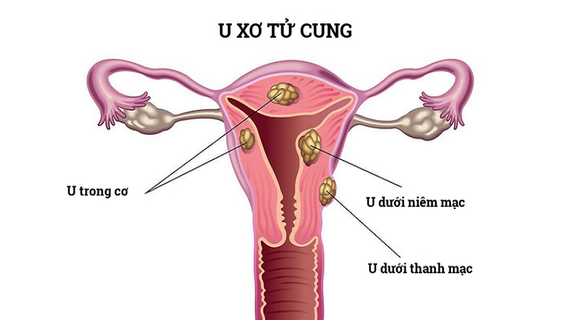 U xơ tử cung có nguy hiểm không? Khi nào cần phẫu thuật cắt bỏ? 1
