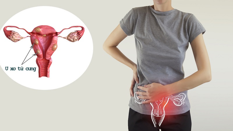U xơ tử cung có nguy hiểm không? Khi nào cần phẫu thuật cắt bỏ? 2