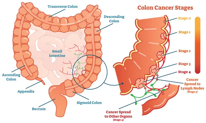 Ung thư đại tràng: Có cần nội soi đại tràng không? 2