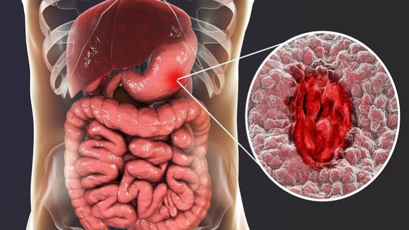 Ung thư giai đoạn 3 có chữa được không? 1