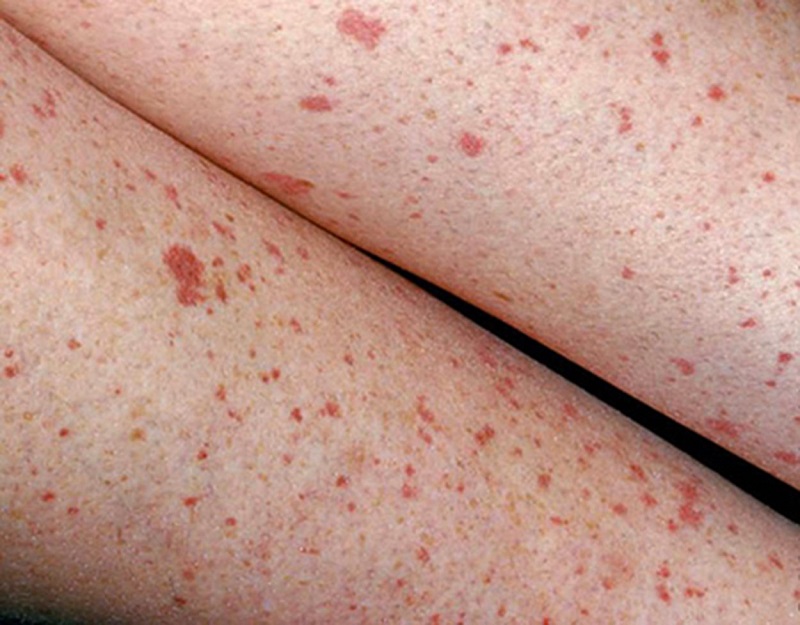 Ung thư máu phát triển dưới dạng nào? Thận trọng với những đốm đỏ ung thư máu 3