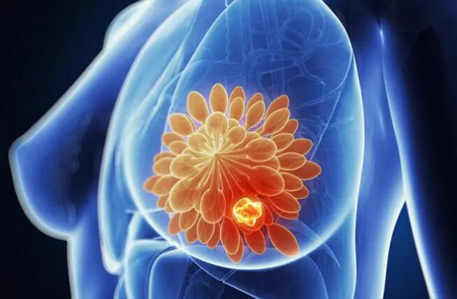 ung-thu-vu-thu-the-noi-tiet-duong-tinh-va-nhung-dieu-can-biet 1.jpg