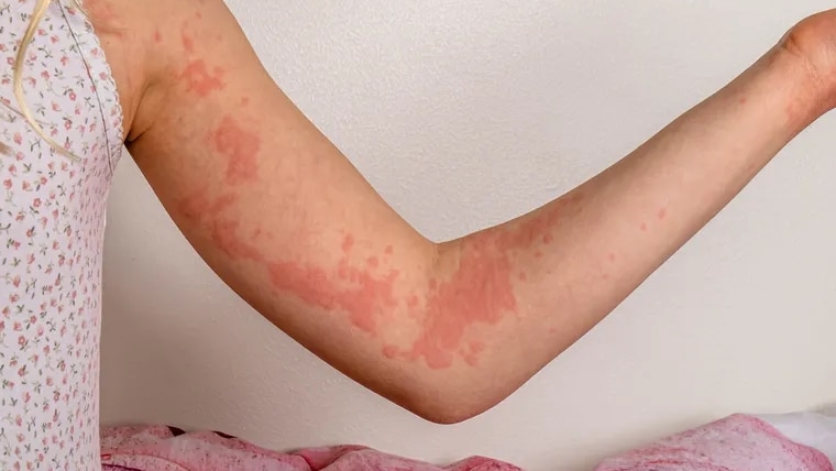 Uống glucosamine có làm mình bị tăng cân không? 3