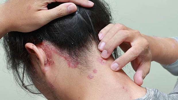 Vảy nến da đầu là gì? Nguyên nhân gây vảy nến da đầu ở trẻ em 1