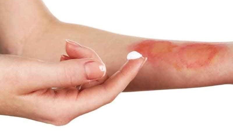 Vết bỏng bị thâm đen do đâu và làm sao để xóa thâm hiệu quả? 1