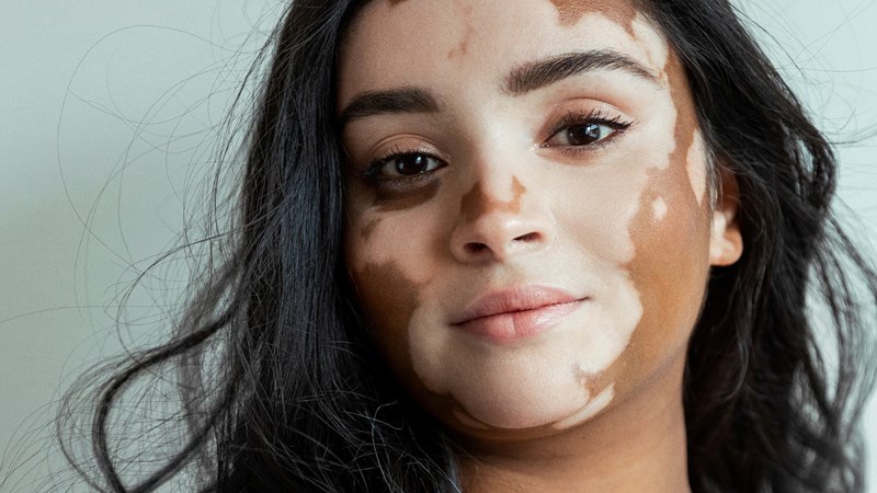 Vết loang trắng trên da: Nguyên nhân và cách can thiệp hiệu quả 2