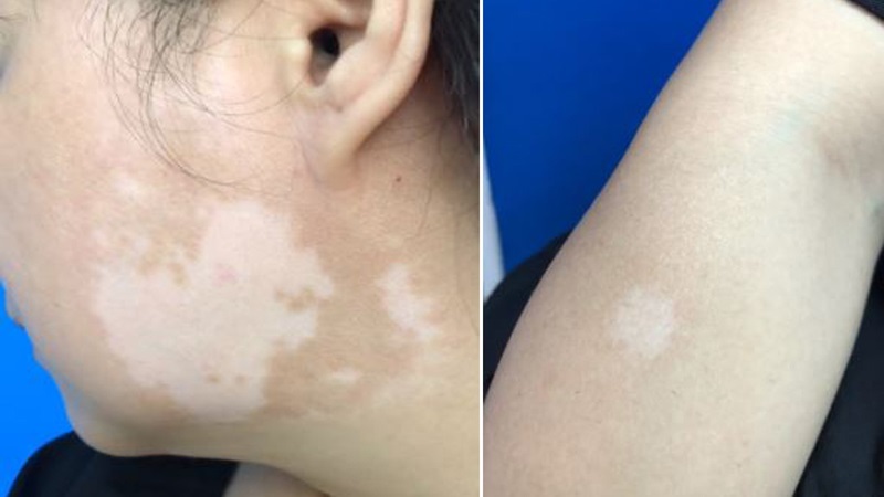 Vết loang trắng trên da: Nguyên nhân và cách can thiệp hiệu quả 3