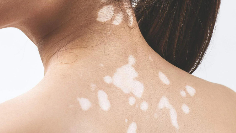 Vết loang trắng trên da: Nguyên nhân và cách can thiệp hiệu quả 4