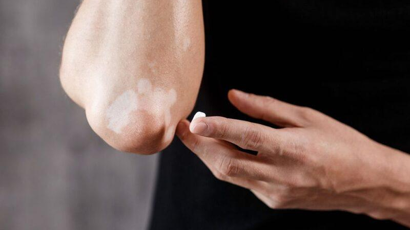 Vết loang trắng trên da: Nguyên nhân và cách can thiệp hiệu quả 5