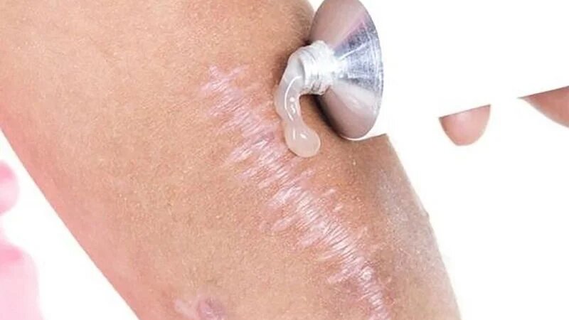 vet-thuong-bi-ngua-khi-moc-da-non-nguyen-nhan-la-do-dau 3.jpg