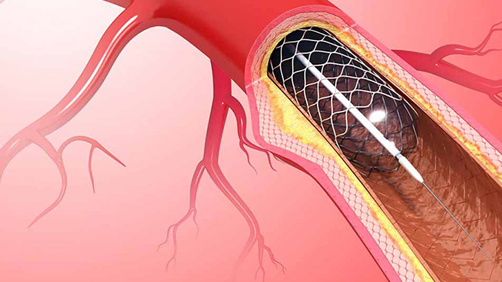 Vết thương mạch máu: Nguyên nhân và cách sơ cứu bạn cần biết 3