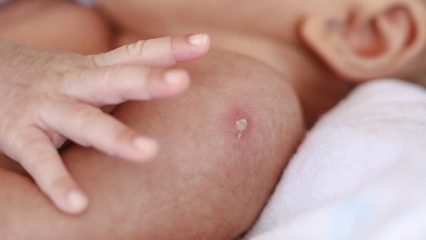 Vết tiêm lao mưng mủ sau 1 tháng có sao không? â