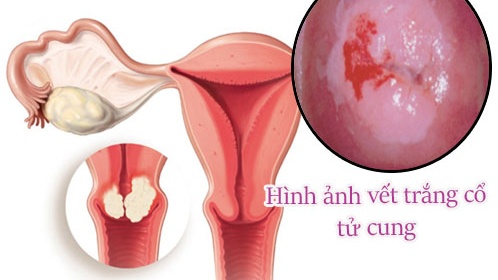 Vết trắng cổ tử cung có phải ung thư không? 1