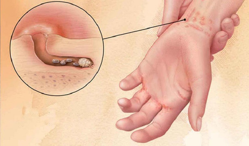 Vì sao bị ghẻ mãi không khỏi và làm thế nào để trị dứt điểm?